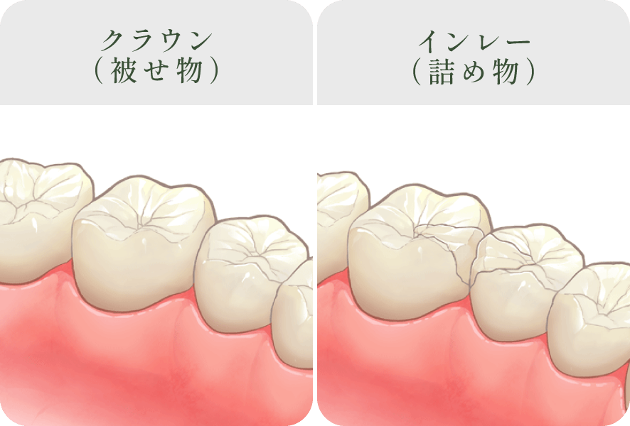 オールセラミック(クラウン/インレー)