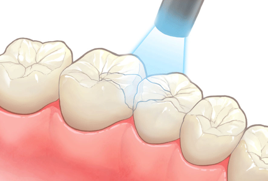 ダイレクトボンディング
