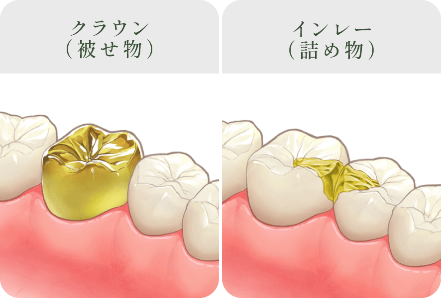 ゴールド(クラウン/インレー)