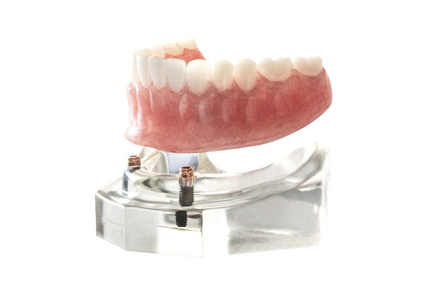インプラントオーバーデンチャー