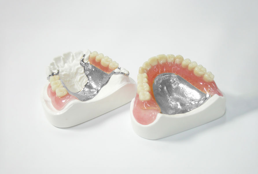 金属床義歯