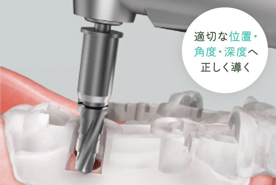サージカルガイド 適切な位置・角度・深度へ正しく導く