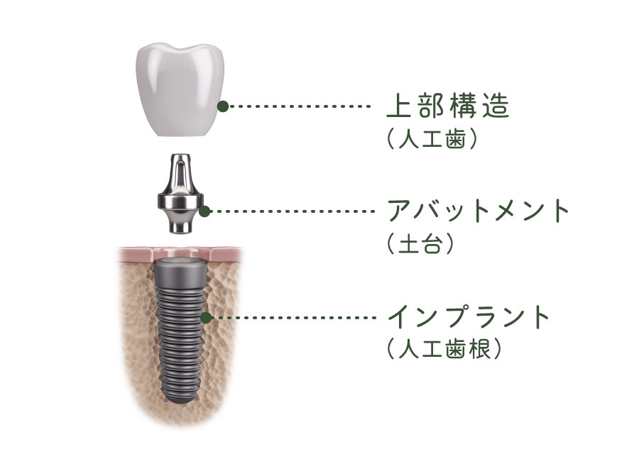 インプラント構造