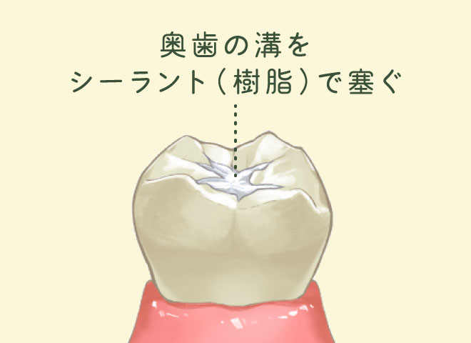 シーラント填塞