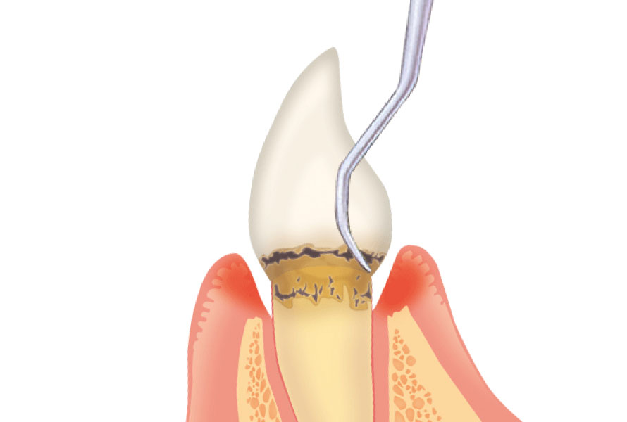 ルートプレーニング