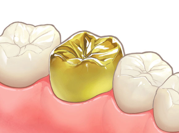 ゴールドクラウン