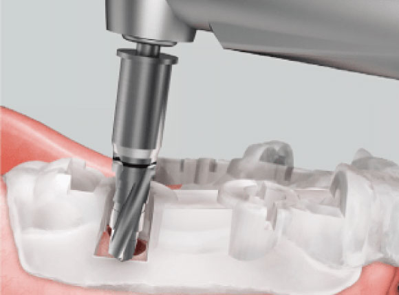 サージカルガイド