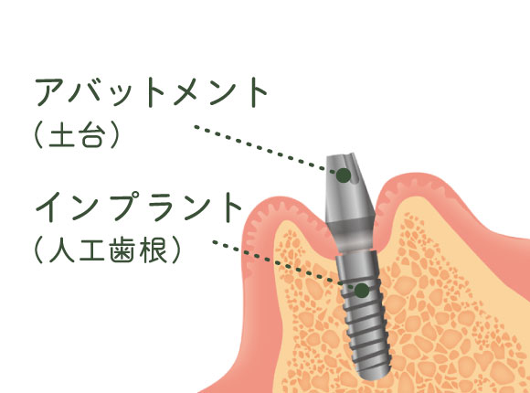 インプラント埋入