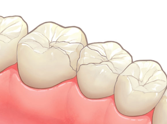 セラミックインレー（e.max）