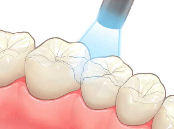 ダイレクトボンディング