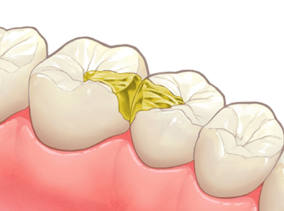ゴールドインレー