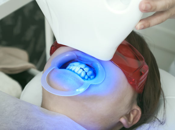 オフィスホワイトニング