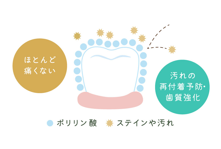 ポリリンホワイトニング